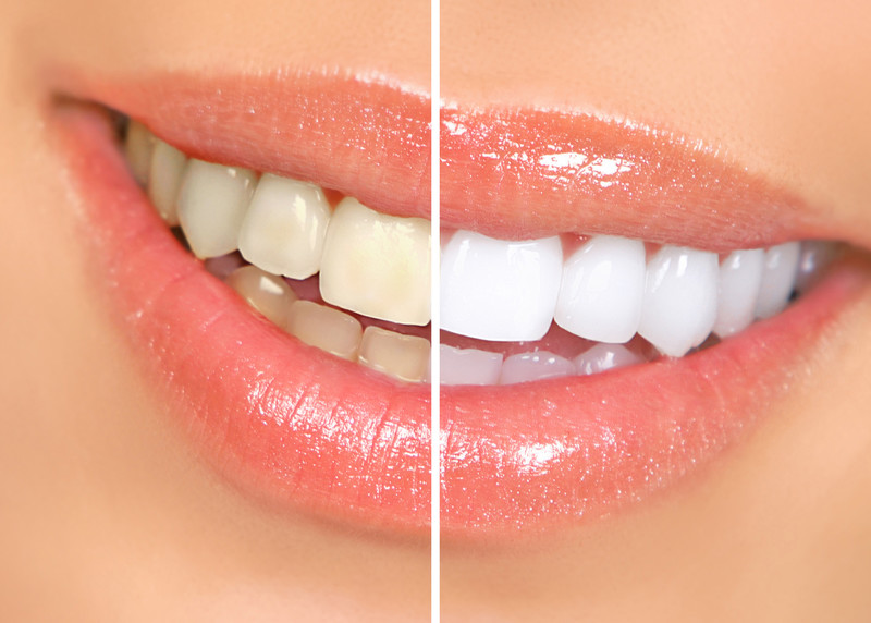 Before and after teeth whitening results showing brighter smile with cosmetic dentistry