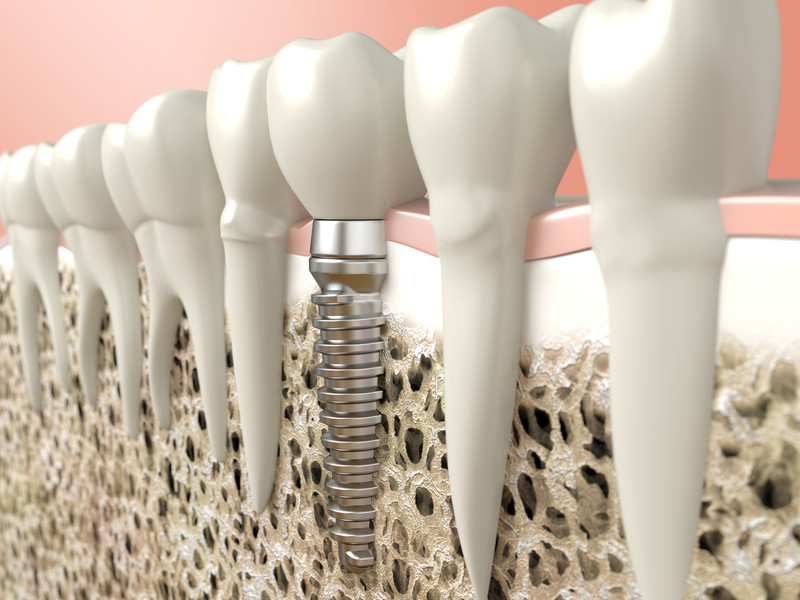 Cross-section of jaw showing single dental implant for tooth replacement