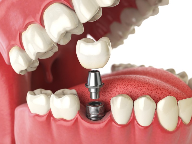Dental model showing a single tooth implant for restorative dentistry Dental model showing a single tooth implant for restorative dentistry
