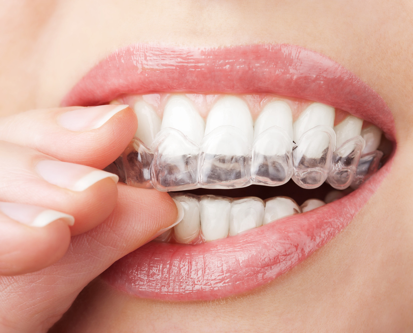 Person inserting Invisalign clear aligner for teeth straightening treatment