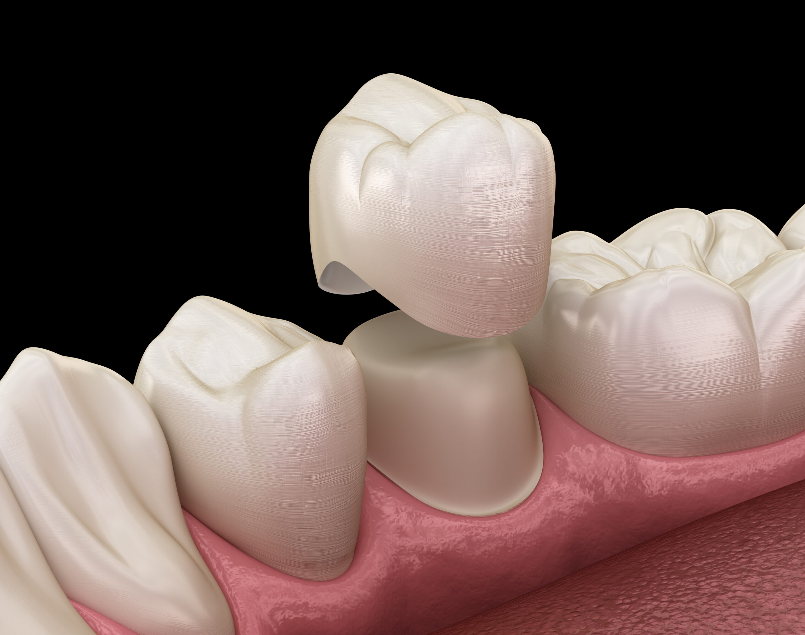 Dental crown premolar tooth assembly process. Medically accurate 3D model of a porcelain dental crown used for same-day restoration at Plainsboro Dental Services in Plainsboro, NJ.