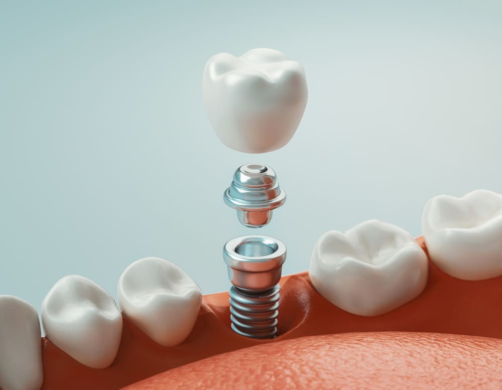 3D model of a single tooth dental implant showing the titanium post and crown at Plainsboro Dental Services in Plainsboro, NJ. 3D model of a single tooth dental implant showing the titanium post and crown at Plainsboro Dental Services in Plainsboro, NJ.