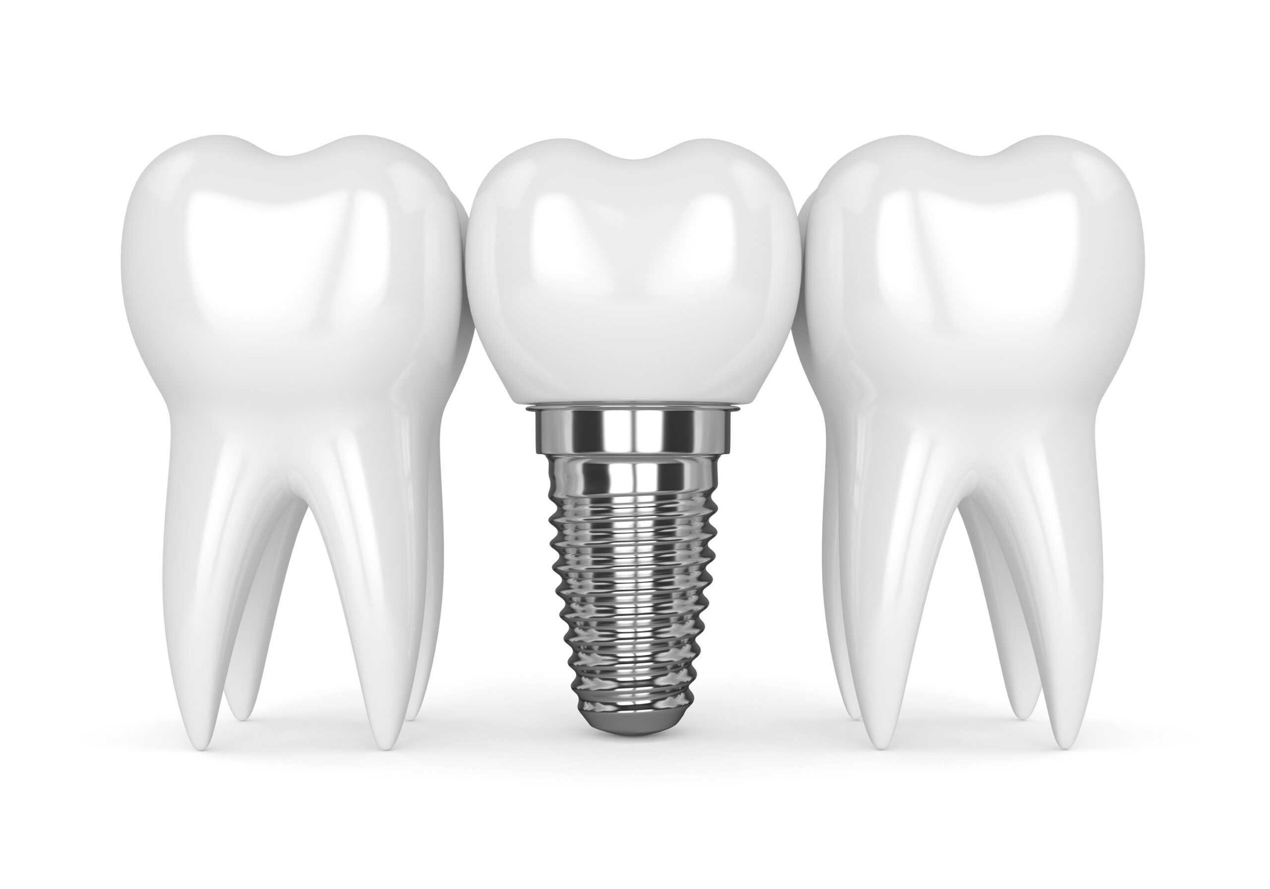Model showing a single tooth dental implant with two adjacent teeth at Plainsboro Dental Services in Plainsboro, NJ. Model showing a single tooth dental implant with two adjacent natural teeth at Plainsboro Dental Services in Plainsboro, NJ.